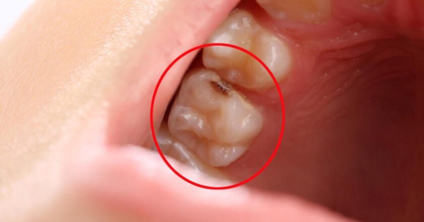 Bu yağ çürümüş dişler için iyidir! Çürüme ağrısı için neyin iyi, nasıl? Dişlerin çürümesi için ağrı evde muamele mi?